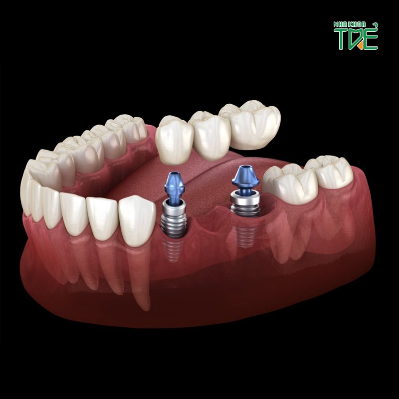 Cầu răng trên Implant là gì? Có tốt không?