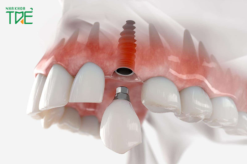 Cấu trúc răng Implant gồm 3 phần trụ răng, abutment và mão sứ