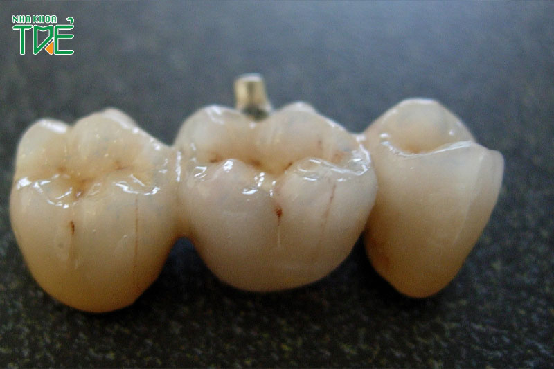 Răng sứ trên Implant kém chất lượng dễ bị mẻ vỡ