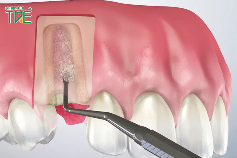 Răng Implant bị vỡ cần làm lại răng sứ mới