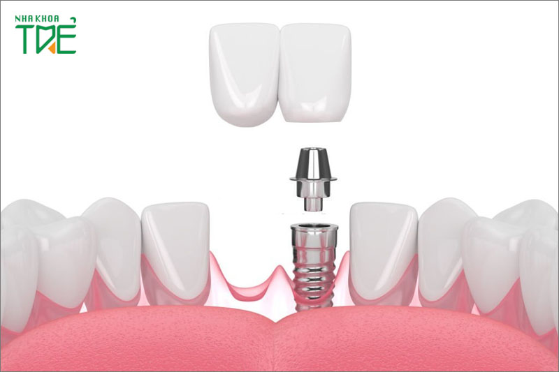 Mất 2 răng liên tiếp cấy 1 trụ Implant được không? Giải pháp nào tốt?