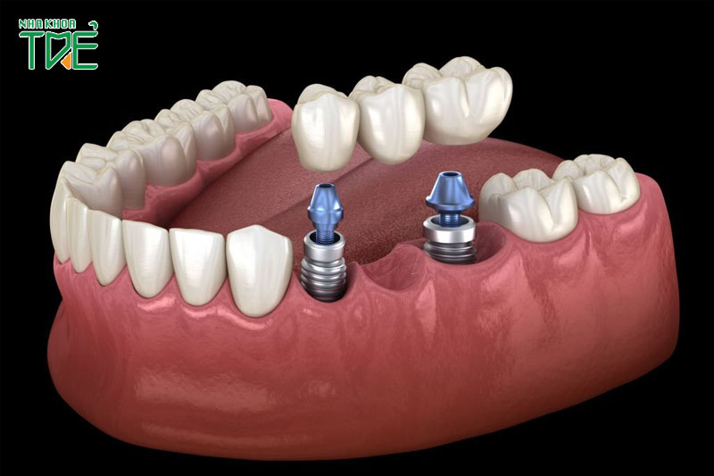 Làm cầu răng trên Implant giúp tiết kiệm chi phí