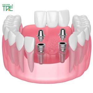 Mất 3 răng liền kề chỉ cấy 2 trụ Implant được không?