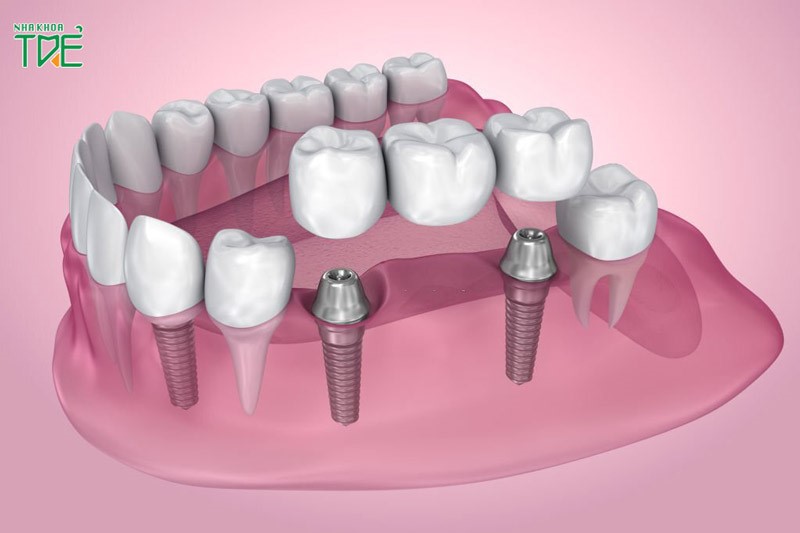 Mất 3 răng liền kề chỉ cấy 2 trụ Implant