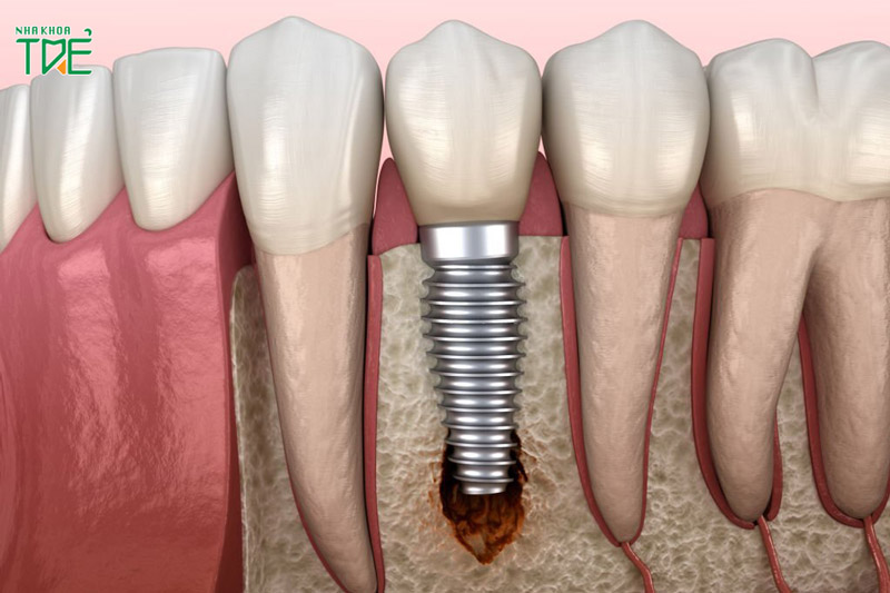 Răng Implant bị xô lệch gây ảnh hưởng nghiêm trọng
