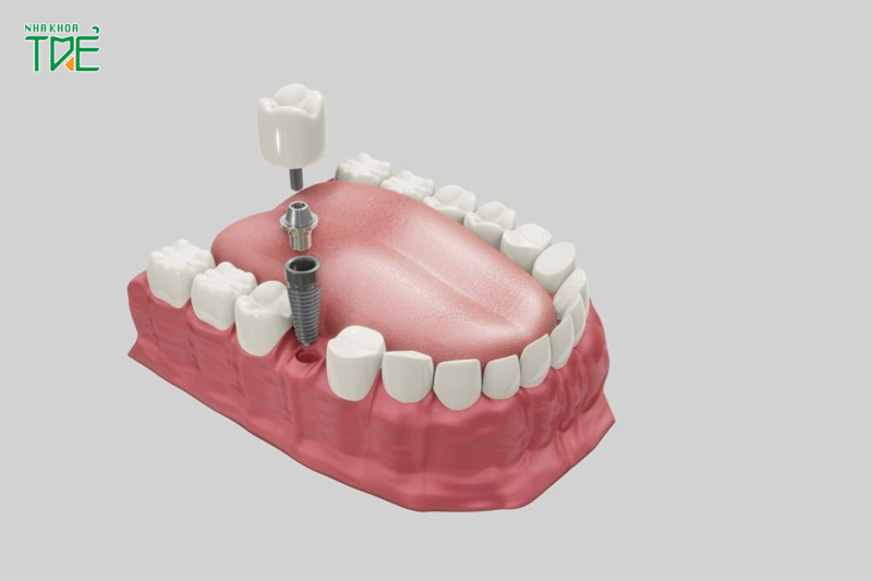 Cấy ghép Implant khi bị mất răng