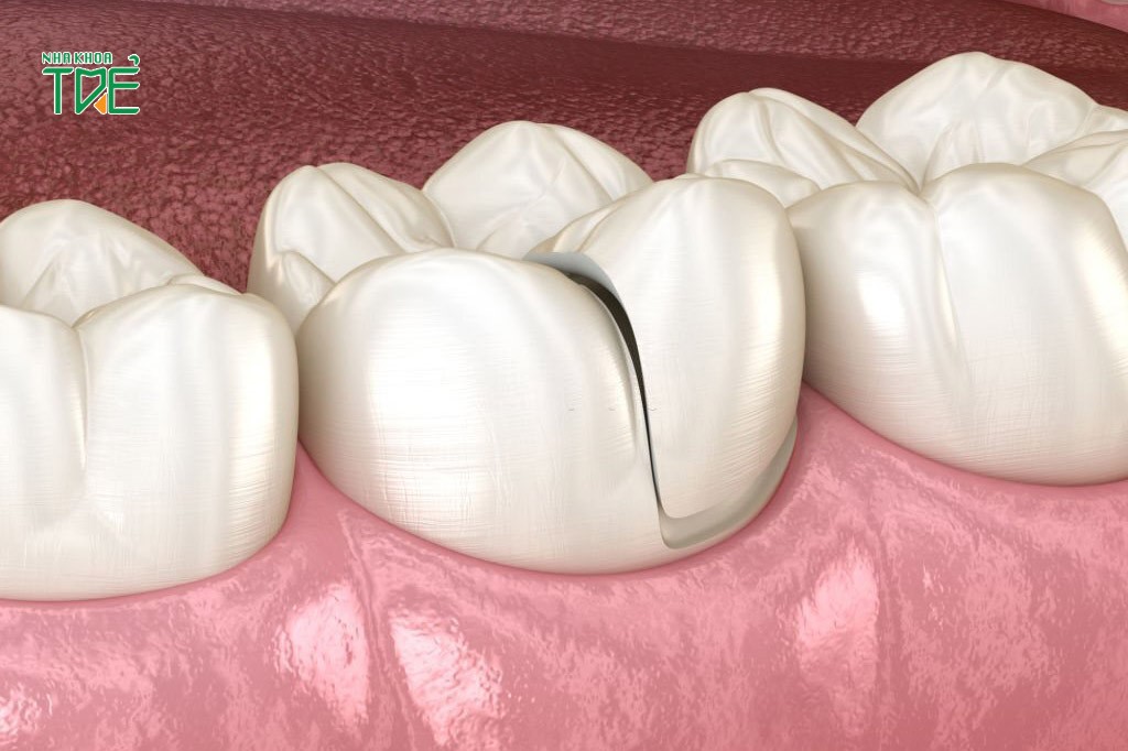 Răng sứ bị mẻ cần khắc phục sớm
