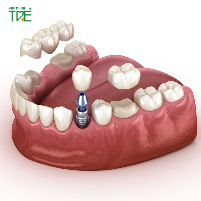 Thay thế cầu răng sứ bằng trồng răng Implant