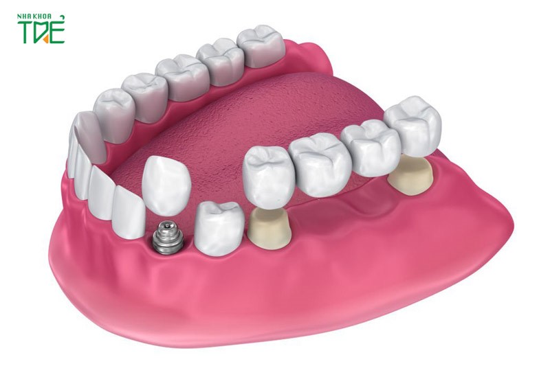 Thay thế cầu răng sứ bằng trồng răng Implant