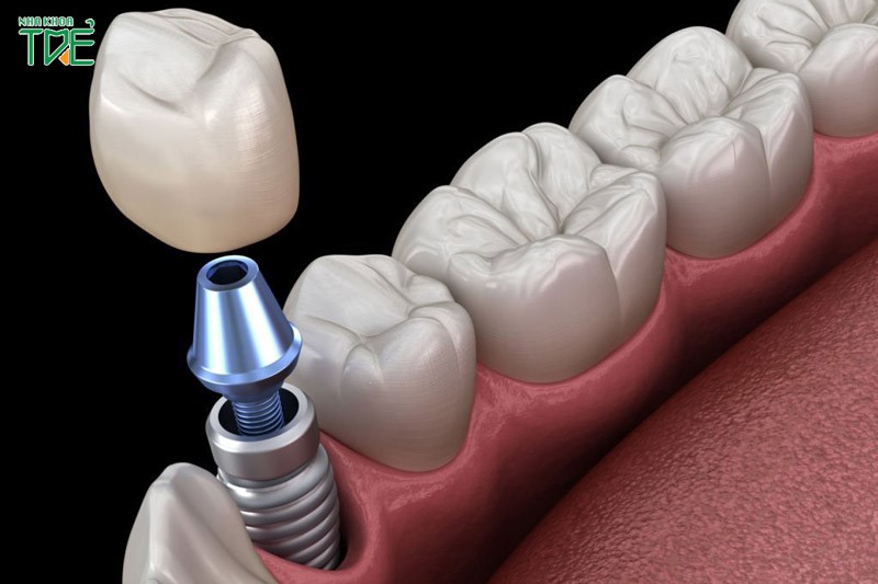 Trẻ 14 tuổi có trồng răng Implant được không?