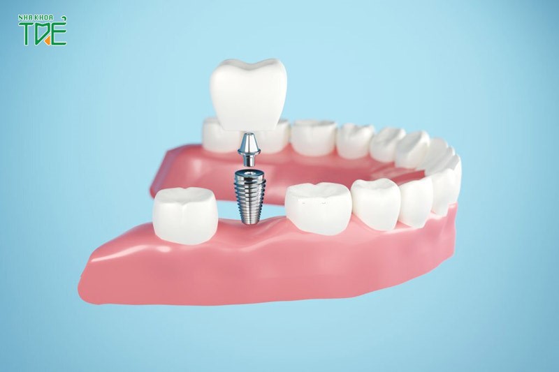 Trồng răng Implant 4s an toàn