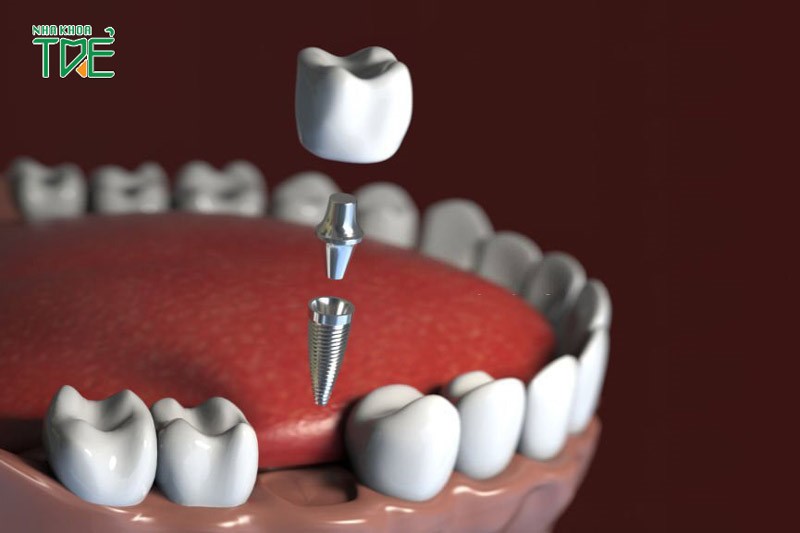 Trồng răng Implant 4s nhanh chóng