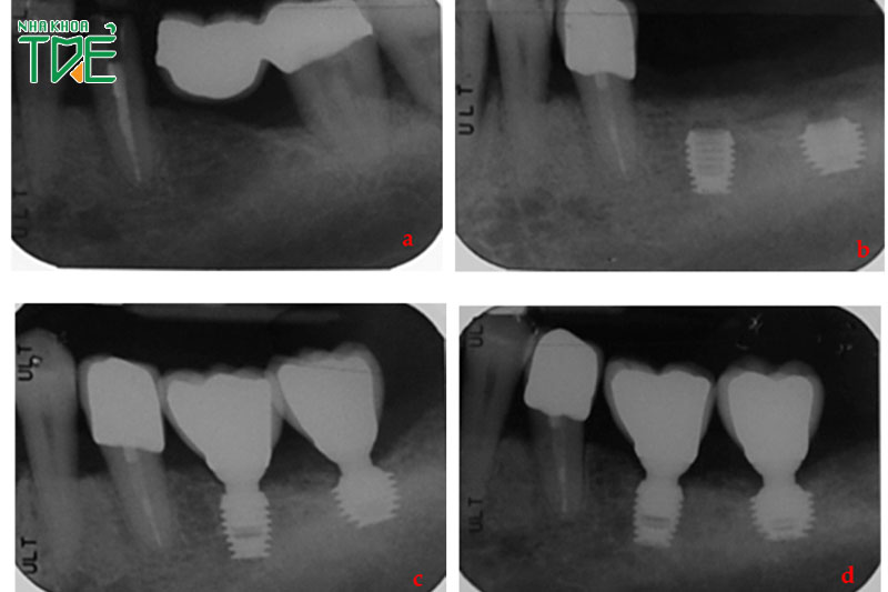 Răng Implant bị viêm cần chẩn đoán dựa trên phim X-quang