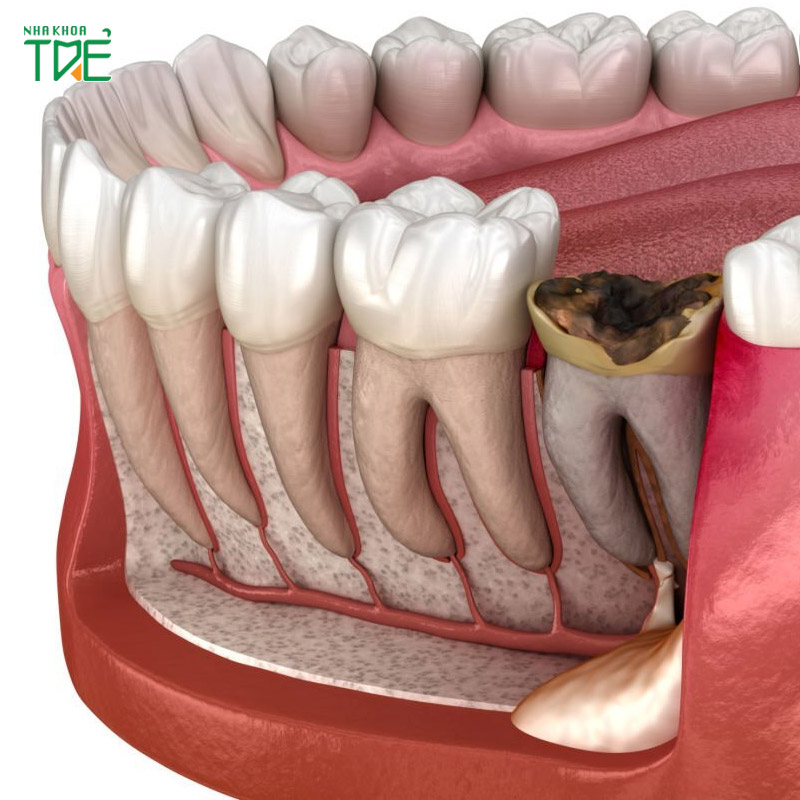Hậu quả mất răng cấm và cách trồng răng phục hình