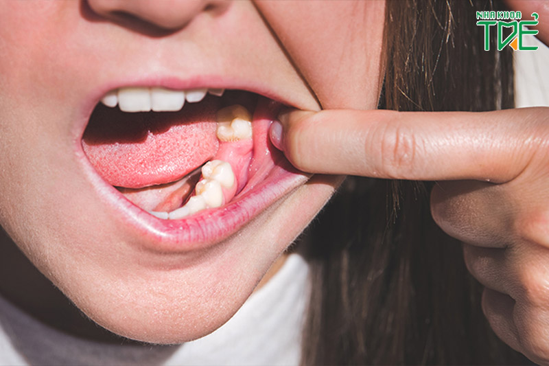 Mất răng gây ra nhiều hậu quả đáng lo ngại