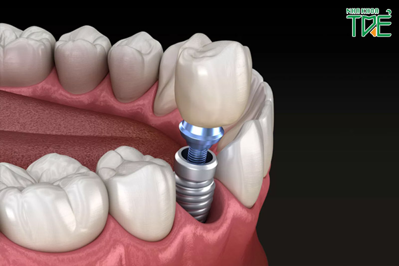 Cấy ghép Implant phuc hình răng mất toàn diện từ chân răng