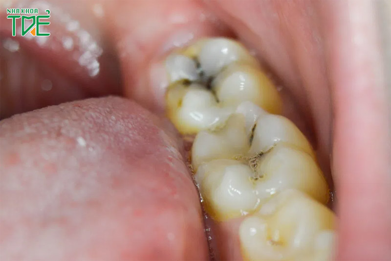 Răng bị chấm đen phải làm sao? Dấu hiệu của bệnh gì?