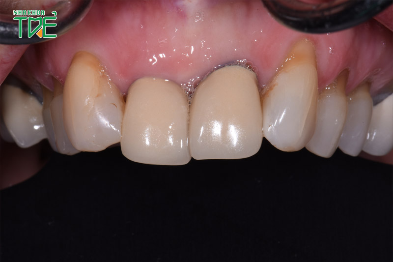 Răng sứ kim loại bị đen do oxi hóa trong khoang miệng
