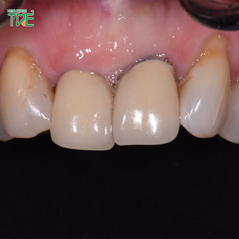 Răng sứ kim loại bị đen viền nướu: Nguyên nhân và cách khắc phục