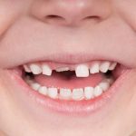 Răng trẻ em bị mẻ vỡ: Tác hại và cách khắc phục kịp thời