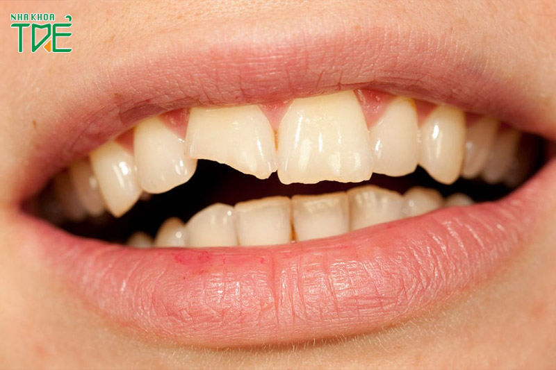 Bọc răng sứ cho các trường hợp răng sứt mẻ nhỏ