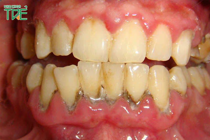 Răng viêm nha chu không nên bọc răng sứ