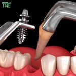 Ưu nhược điểm trồng răng Implant | Có nên cấy Implant không?