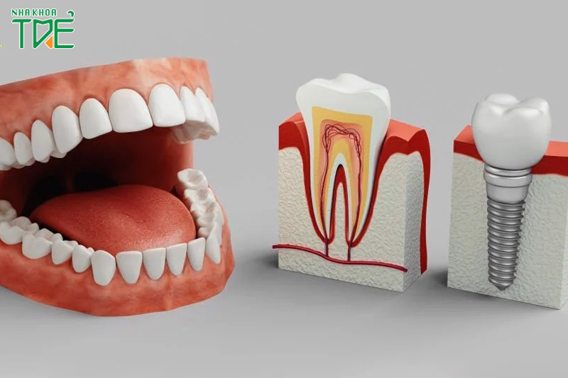 Ưu nhược điểm của trồng răng Implant là gì?