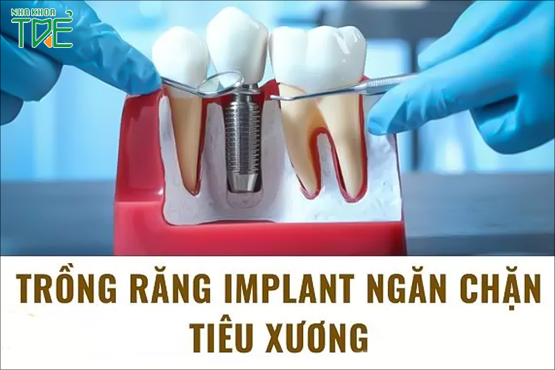 Ưu điểm nổi bật của trồng răng Implant