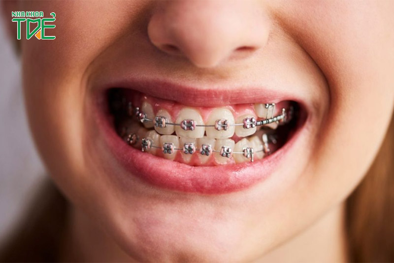Niềng răng có tác dụng gì? 10 lợi ích đạt được khi răng thẳng đều