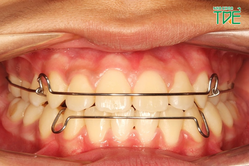 Giai đoạn cuối duy trì sự ổn định của hàm răng
