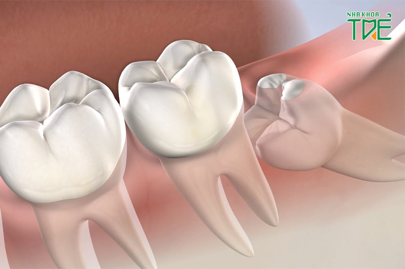 Răng khôn có tác dụng gì? Trường hợp nào cần nhổ răng khôn?
