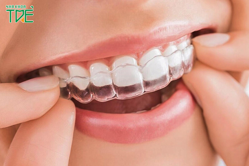 Phương pháp niềng răng khắc phục tình trạng răng thưa, hô, móm, khấp khểnh