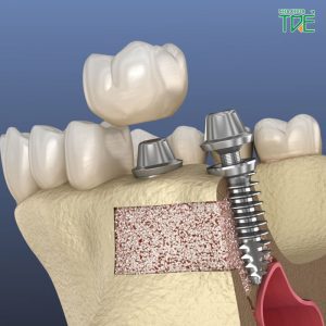 Những tiêu chuẩn xương hàm trong cấy ghép Implant