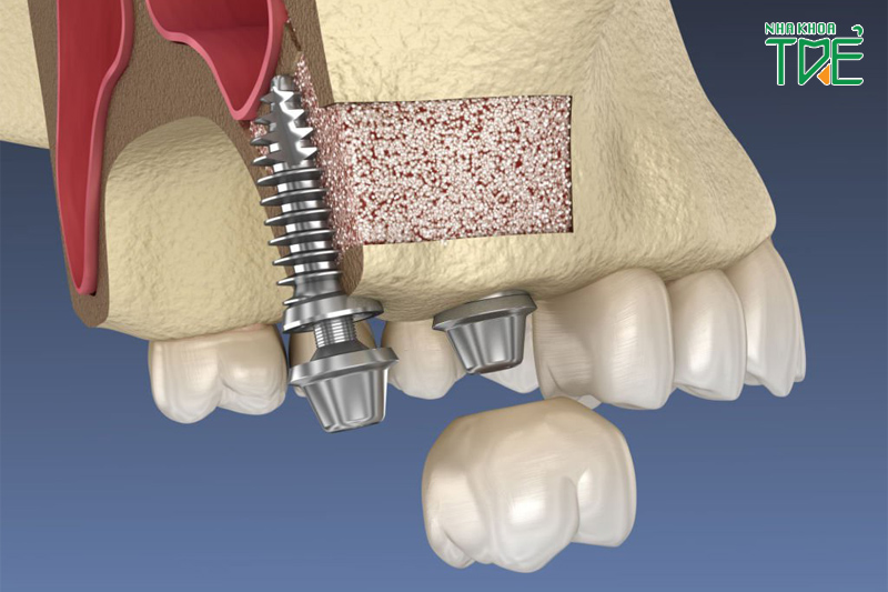 Người bị tiêu xương hàm cần ghép xương, nâng xoang hàm trước khi cấy ghép Implant