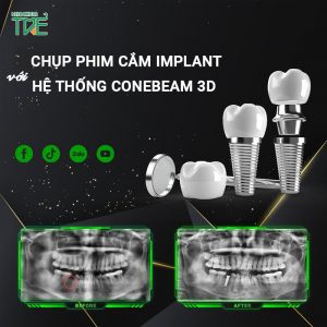 Chụp phim cắm Implant an toàn, chính xác với hệ thống ConeBeam 3D