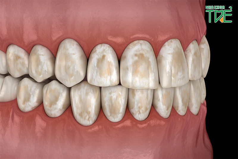 Răng nhiễm fluor, màu kháng sinh là một trong những trường hợp nên dán sứ Veneer