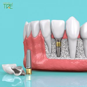 Đối tượng nên trồng răng Implant và thời điểm phục hình phù hợp nhất