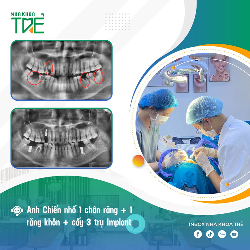 Khách hàng nhổ 1 chân răng và cấy 3 trụ Implant