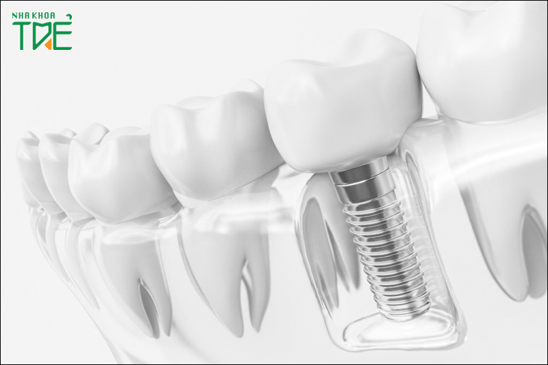 Cấy ghép Implant phục hình răng số 7 bị mất do lung lay nặng