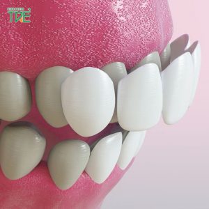 [Update 2023] Dán sứ cho răng thưa giá bao nhiêu?