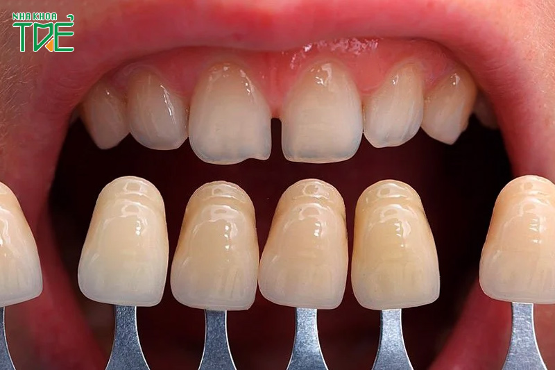 Dán sứ cho răng thưa giá bao nhiêu còn phụ thuộc vào nhiều yếu tố