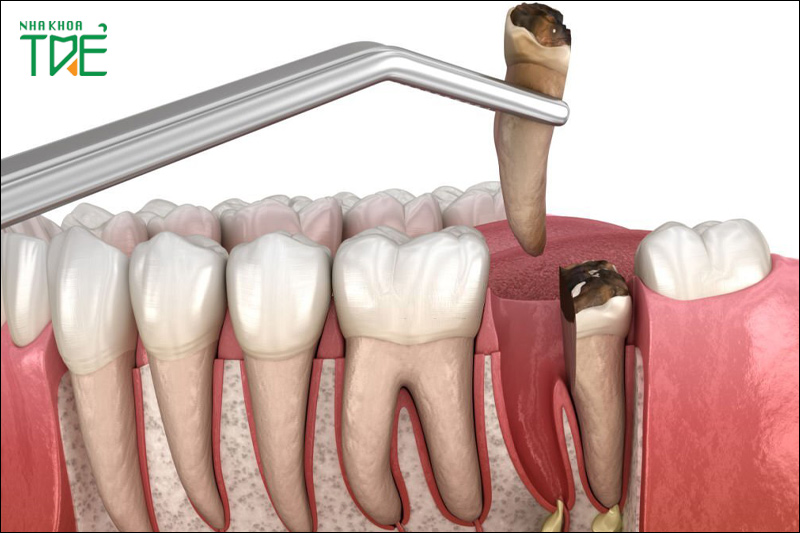 Răng sâu nặng, không thể khắc phục cần thực hiện nhổ răng