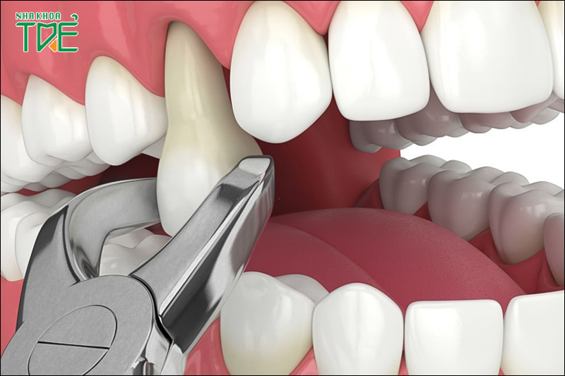 Những điều cần biết về nhổ răng hàm trên