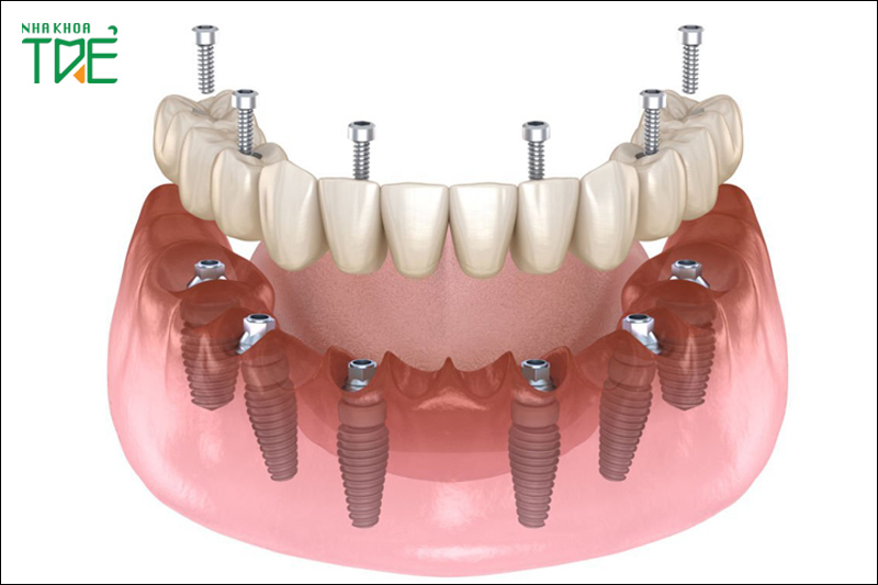 Người mất nhiều răng hay mất toàn hàm đều có thể trồng Implant