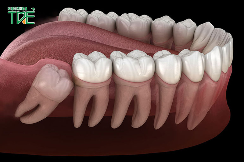 Răng khôn mọc lệch, mọc ngầm là một trong những trường hợp cần nhổ răng