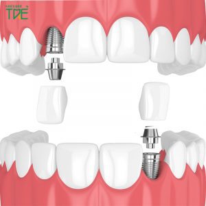 Răng tạm trên Implant có tác dụng gì? Quy trình thực hiện