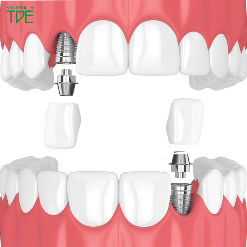 Răng tạm trên Implant có tác dụng gì? Quy trình thực hiện