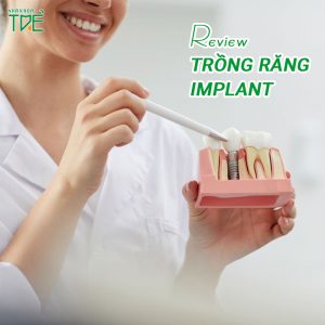 Review trồng răng Implant chi tiết: Thời gian cấy ghép? Có đau không?