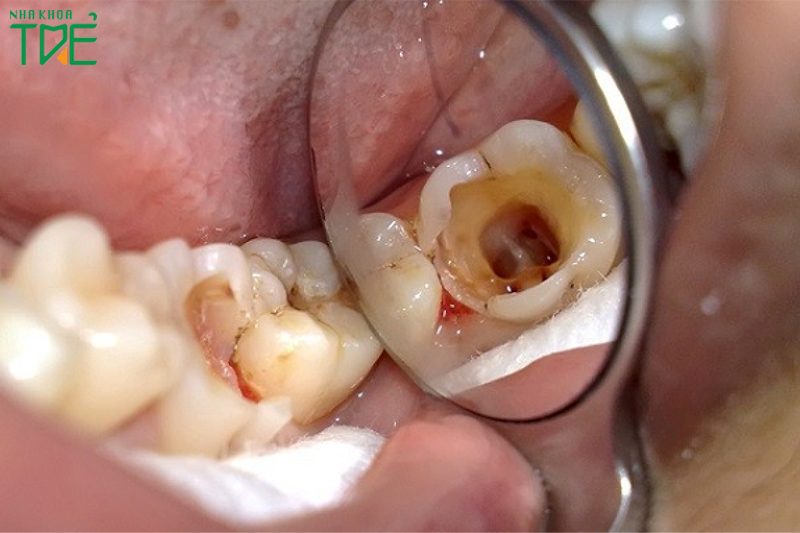 Nếu răng bị sâu quá nặng, bạn nên thực hiện lấy tủy.